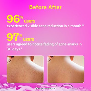 Chemist at Play Salicylic Acid Body Wash for Acne Control- 473ml